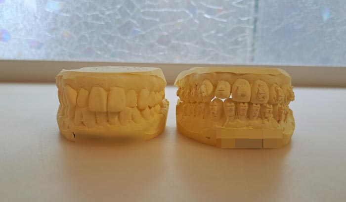 調整中とはいえ、矯正前（左）の歯型と比べるとその差は歴然です（C）コクハク