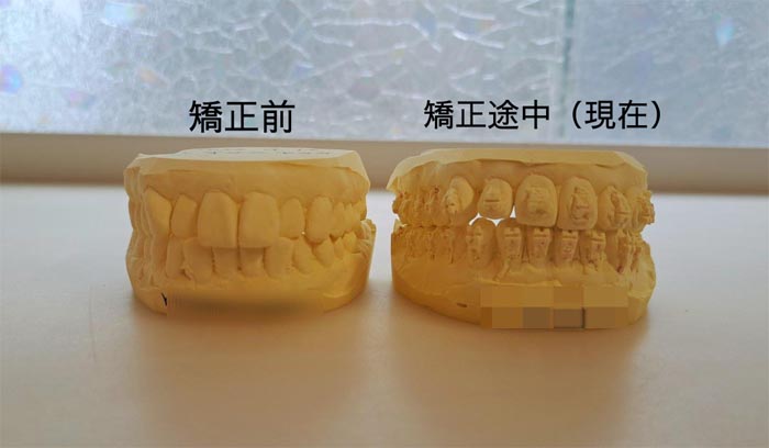 「1番」と呼ばれる前歯2本が引っ込み、「2番」と呼ばれる側切歯ときれいに並び始めました（C）コクハク