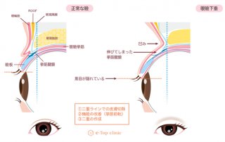 眼瞼下垂のイラスト（イートップクリニック提供／無断転載禁止）