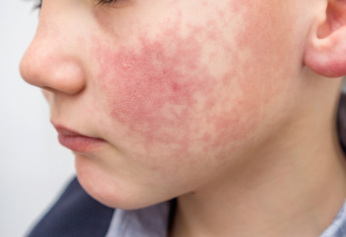 肌荒れの原因に（写真:iStock）