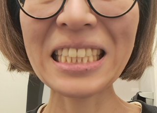 【45歳からの歯科矯正】2年後の47歳でひとまず終了。ワイヤー矯正をやって後悔、失敗したことは？